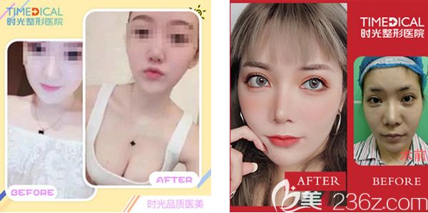 兰州时光贾志兰假体隆胸+双眼皮失败修复效果怎么样 兰州时光贾志兰假体隆胸+双眼皮失败修复效果怎么样