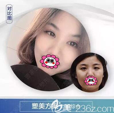 郴州曹家整形眼综合真人前后对比效果