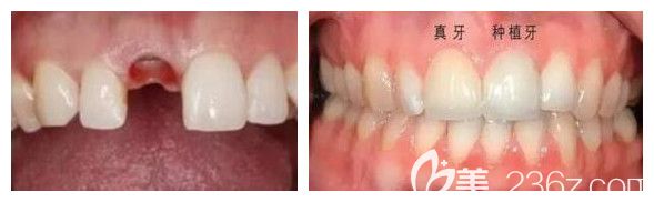 郑州拜博口腔王中杰主任前牙种植效果 郑州拜博口腔王中杰主任前牙种植效果