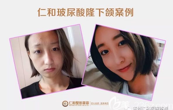 兰州仁和叶海云玻尿酸隆下颌+提眉切眉案例