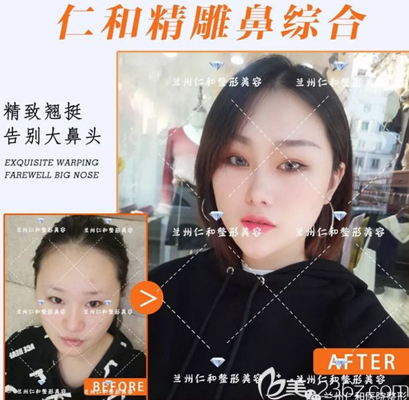 兰州仁和整形陶宏伟硅胶隆鼻+自体肋软骨综合隆鼻案例