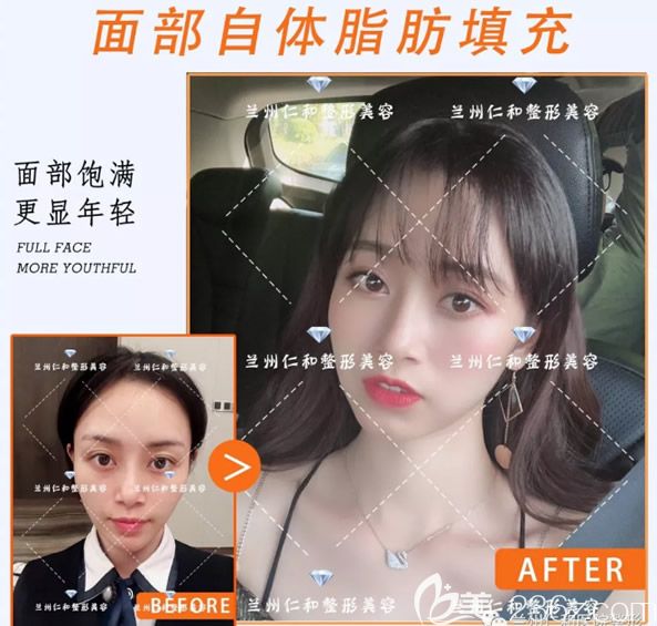 兰州仁和整形刘庆阳医生全脸脂肪填充前后效果对比图