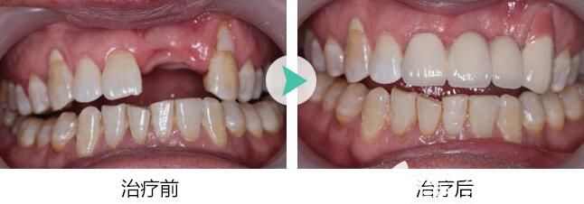 郑州拜博口腔王咲予院长单颗种植牙效果图 郑州拜博口腔王咲予院长单颗种植牙效果图