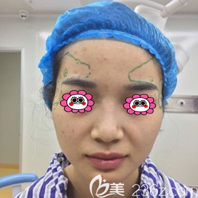 面部脂肪填充手术当天