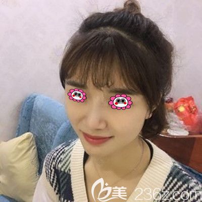 全脸脂肪填充第7天照片