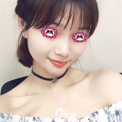 面部脂肪填充30天恢复照片效果