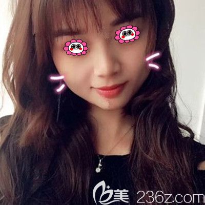 闺蜜陪我到常德伊丽莎白做面部脂肪填充三个月后，决定找卢开锐做双眼皮