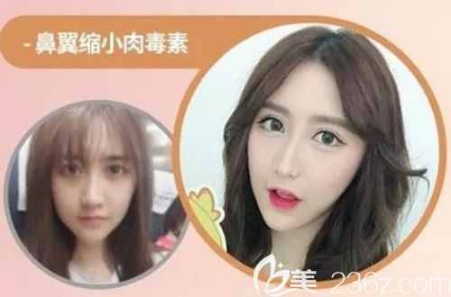 韩国缪慈瘦脸除皱缩小鼻翼案例 韩国缪慈瘦脸除皱缩小鼻翼案例
