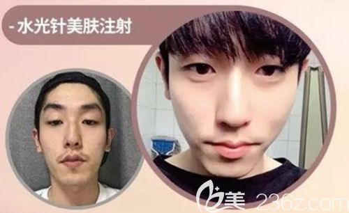 韩国缪慈注射美肤案例 韩国缪慈注射美肤案例