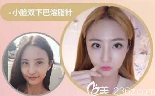 韩国缪慈双下巴溶脂案例 韩国缪慈双下巴溶脂案例
