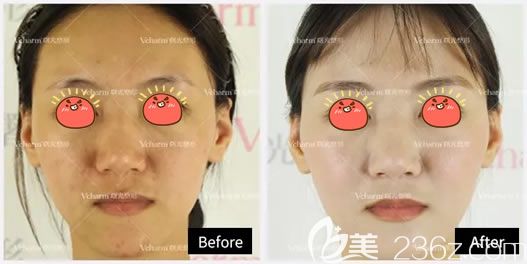 嘉兴曙光玻尿酸填充<span style=