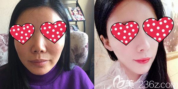 西宁时光医生硅胶假体垫鼻梁+自体肋软骨垫鼻尖综合隆鼻效果图