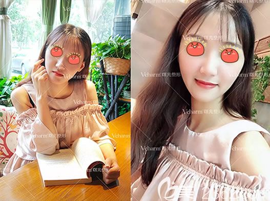 我就想微微整一下,于是我选择嘉兴曙光注射乔雅登玻尿酸进行面部填充提升