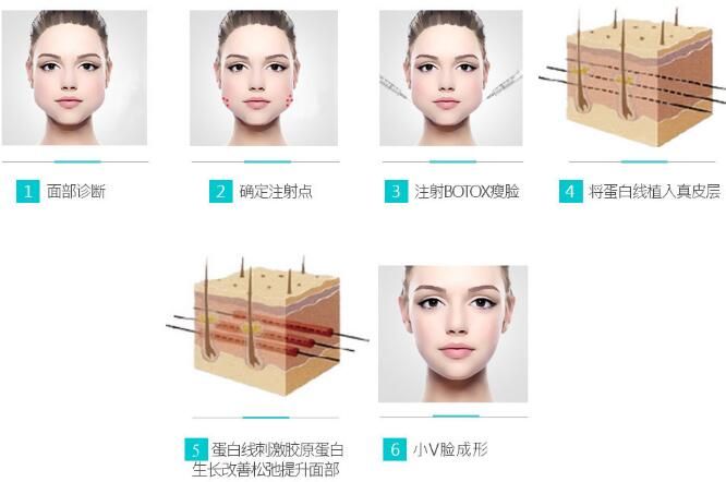 无锡爱思特小V脸提升术操作流程 无锡爱思特小V脸提升术操作流程