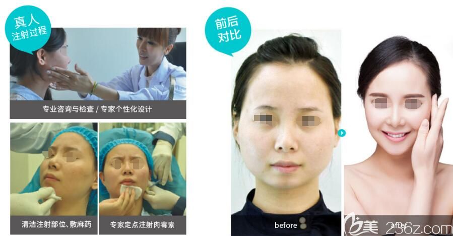 美国瘦脸实力打造V脸,综合改善肌肉型大脸 美国瘦脸实力打造V脸,综合改善肌肉型大脸