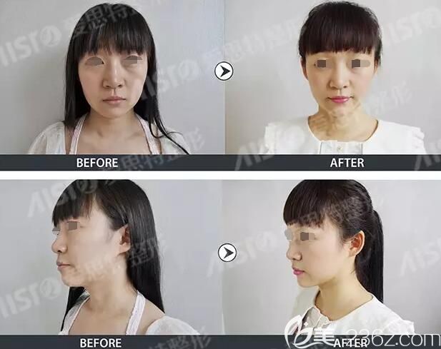 玻尿酸+线拉提升术改善面部凹陷,提拉下垂面部组织 玻尿酸+线拉提升术改善面部凹陷,提拉下垂面部组织