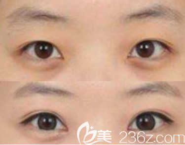 韩国BBC整形外科医院双眼皮真人案例 韩国BBC整形外科医院双眼皮真人案例