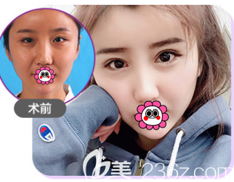 北京美莱<!--<i data=20240703-sp></li>
<li><i data=20240703-sp></i>-->眼修复案例