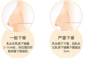 乳房下垂矫正示意图