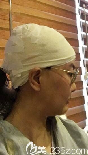 韩国爱婷整形医院骨水泥填充后脑勺术后效果图