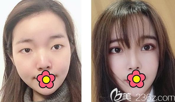 兰州韩美吕娟霞真人全切双眼皮+自体脂肪面部填充前后效果对比案例