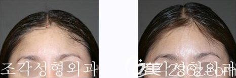 韩国雕刻整形医院宋龙泰骨水泥填充头顶案例效果对比图