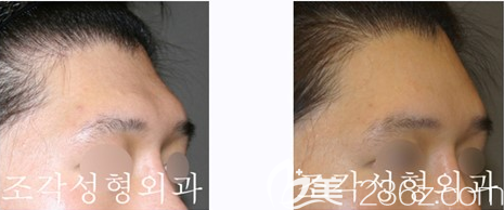 韩国雕刻整形医院骨水泥填充额头案例效果对比图