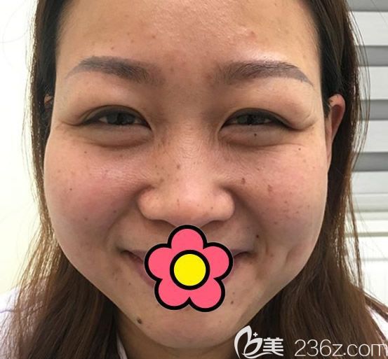 兰州韩美整形陈诚主任做皮秒激光祛斑前 兰州韩美整形陈诚主任做皮秒激光祛斑前