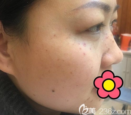 皮秒激光祛斑第五天图片 皮秒激光祛斑第五天图片