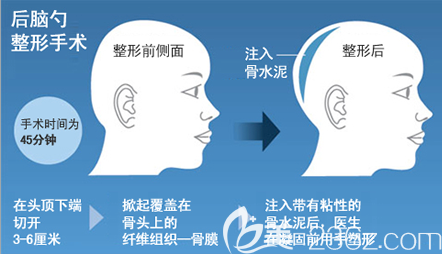骨水泥后脑勺填充手术示意图
