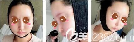 上海愉悦美联臣医疗美容医院下颌角整形真人案例术后第三天
