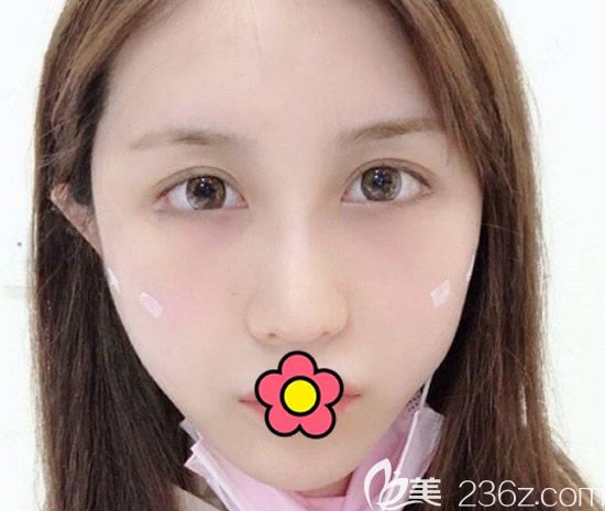 兰州韩美面部线雕第3天效果 兰州韩美面部线雕第3天效果