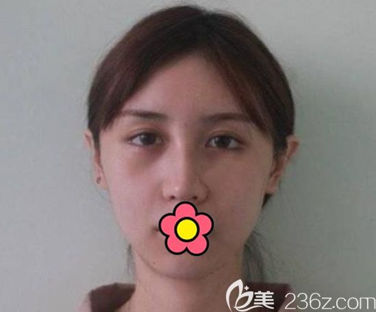 兰州韩美整形医院找面部埋线提升前 兰州韩美整形医院找面部埋线提升前