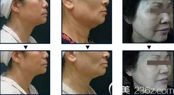 韩国美璞儿超第刀第三代案例效果对比图 韩国美璞儿超第刀第三代案例效果对比图