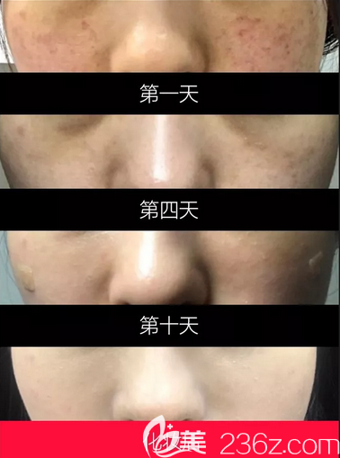 韩国美璞儿激光去色斑+光子嫩肤案例效果对比图 韩国美璞儿激光去色斑+光子嫩肤案例效果对比图