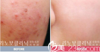 韩国Renovo激光祛痘案例 韩国Renovo激光祛痘案例