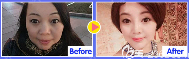 遵义韩美线雕提升 遵义韩美线雕提升