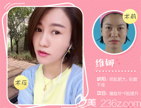 遵义韩美打瘦脸效果怎么样 遵义韩美打瘦脸效果怎么样