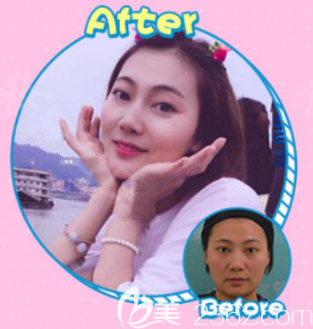 遵义韩美玻尿酸填充全脸案例