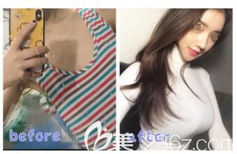 廉锋主任隆胸案例 廉锋主任隆胸案例