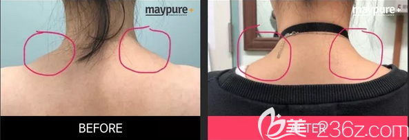 韩国美璞儿张俊哲瘦肩注射位置图片前后效果对比 韩国美璞儿张俊哲瘦肩注射位置图片前后效果对比