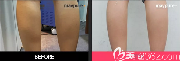 韩国美璞儿瘦腿图片对比照片 韩国美璞儿瘦腿图片对比照片