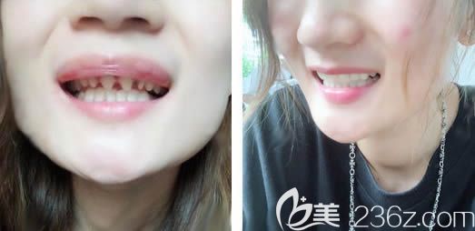 厦门登特口腔詹明毅全瓷牙修复效果对比图