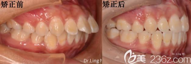 重庆维乐口腔牙齿矫正案例 看这两位顾客做完深覆盖和深覆合矫正后是如何评价的?