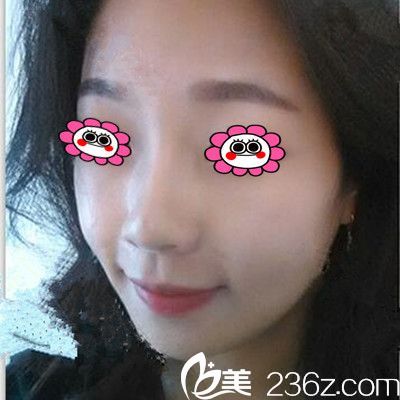 在衡阳曹家整形隆鼻前的照片 在衡阳曹家整形隆鼻前的照片