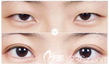 东莞缔美韩先奎做双眼皮怎么样