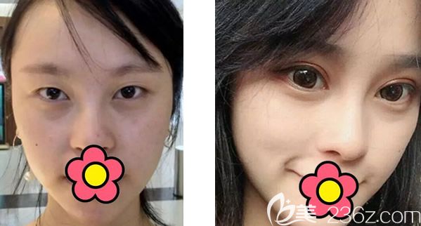 呼和浩特大韩陈琳院长真人全切双眼皮7mm第七天拆线后