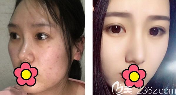 呼和浩特大韩隆鼻整形怎么样