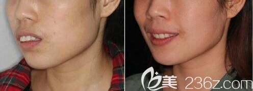 中山好民生雷永正龅牙矫正前后效果对比图 中山好民生雷永正龅牙矫正前后效果对比图