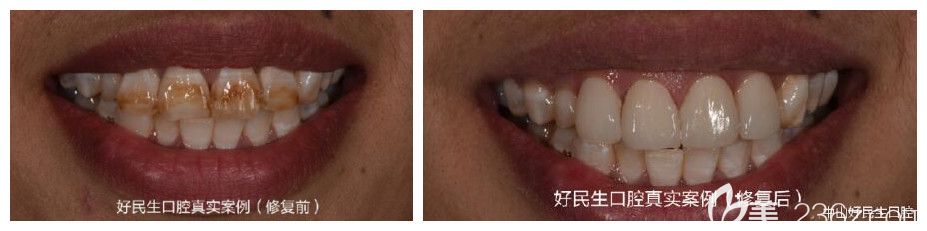 中山好民生口腔雷永正怎么样?雷院长精品案例呈现 中山好民生口腔雷永正怎么样?雷院长精品案例呈现